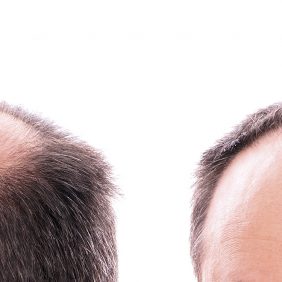 A perda de cabelo e Tratamento da Perda de Cabelo – o Planeta de bem-estar